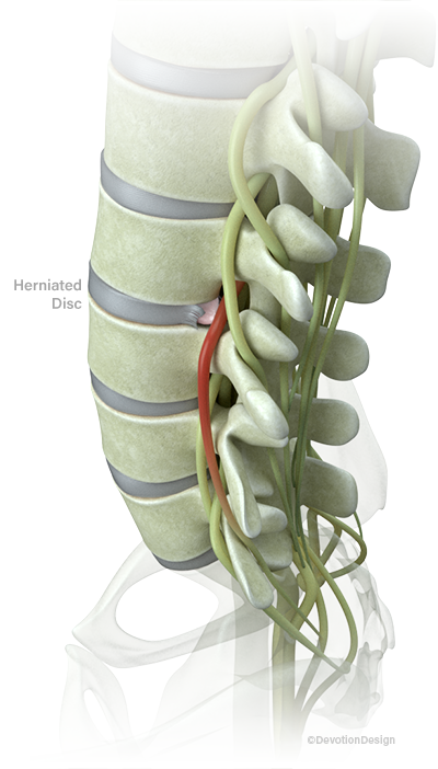 Herniated Disc