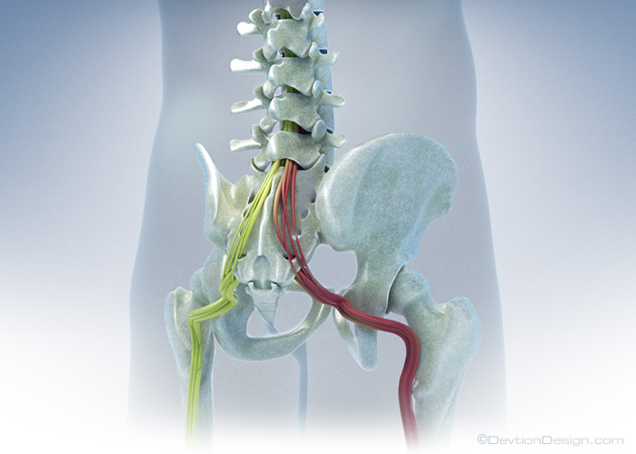 Degenerative Disc Disease