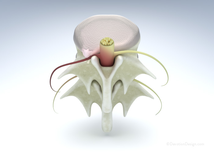 Herniated Disc